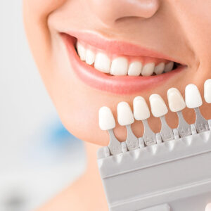 19/10/2024 - Tooth Whitening - Trattamento di discromie ed opacità